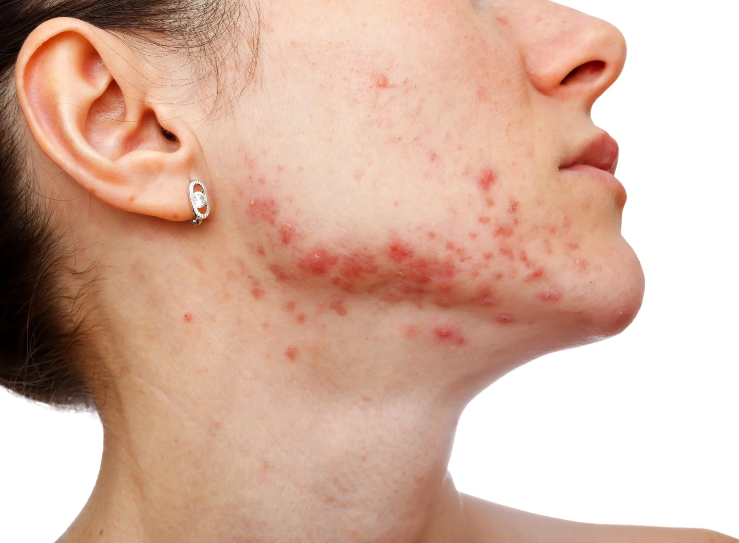 How Does Stress Affect Acne? – Best Ways To Treat Stress Acne